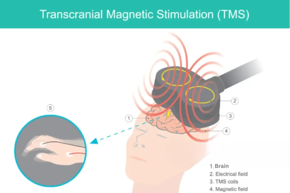 TMS Effectiveness